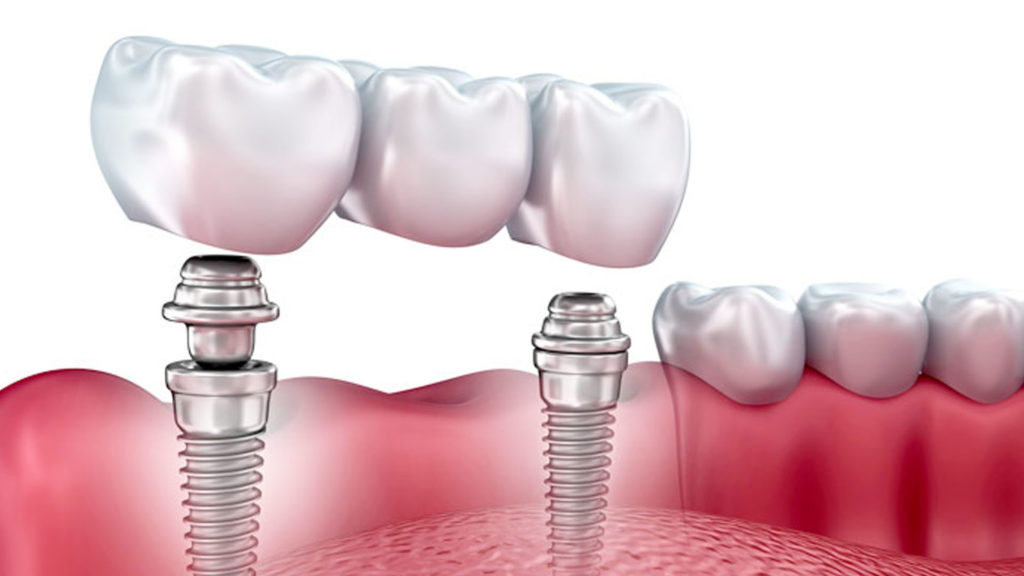 конструкция зубных имплантов