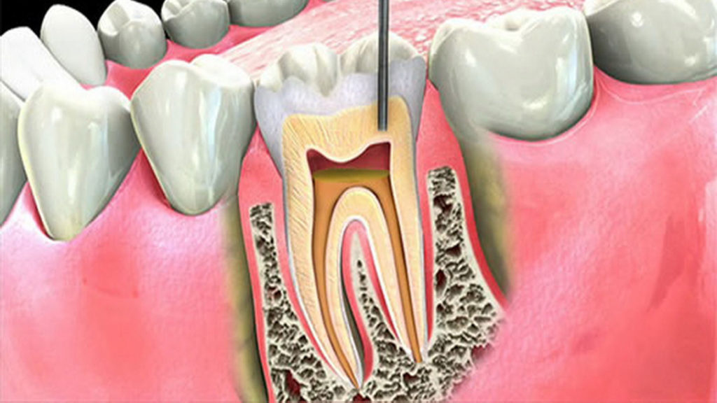 Лечение зубного нерва