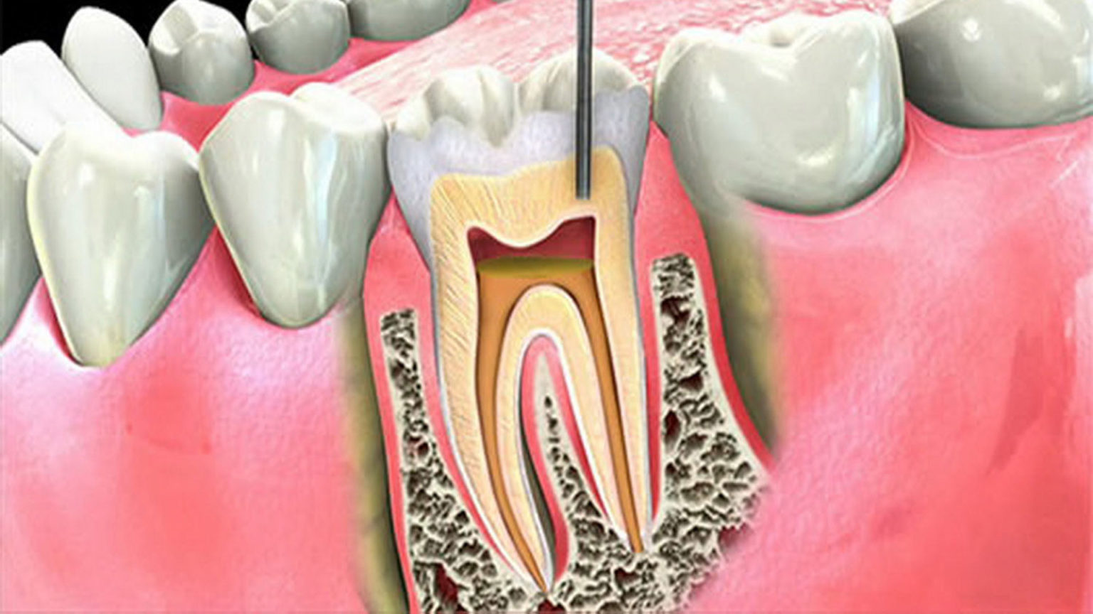 Временное пломбирование корневых. 4 Канальный пульпит зуба. Периодонтит эндодонтия.